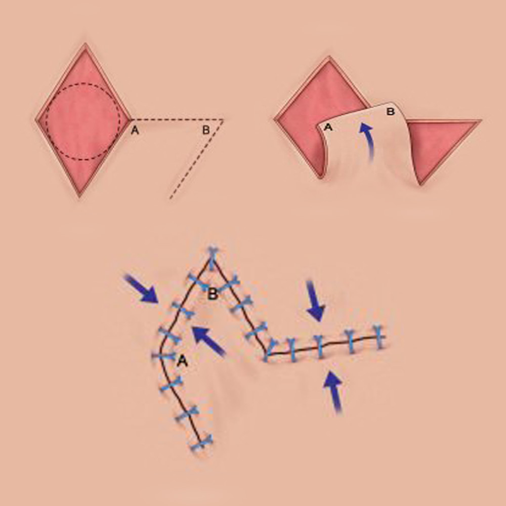 Flap Reconstruction