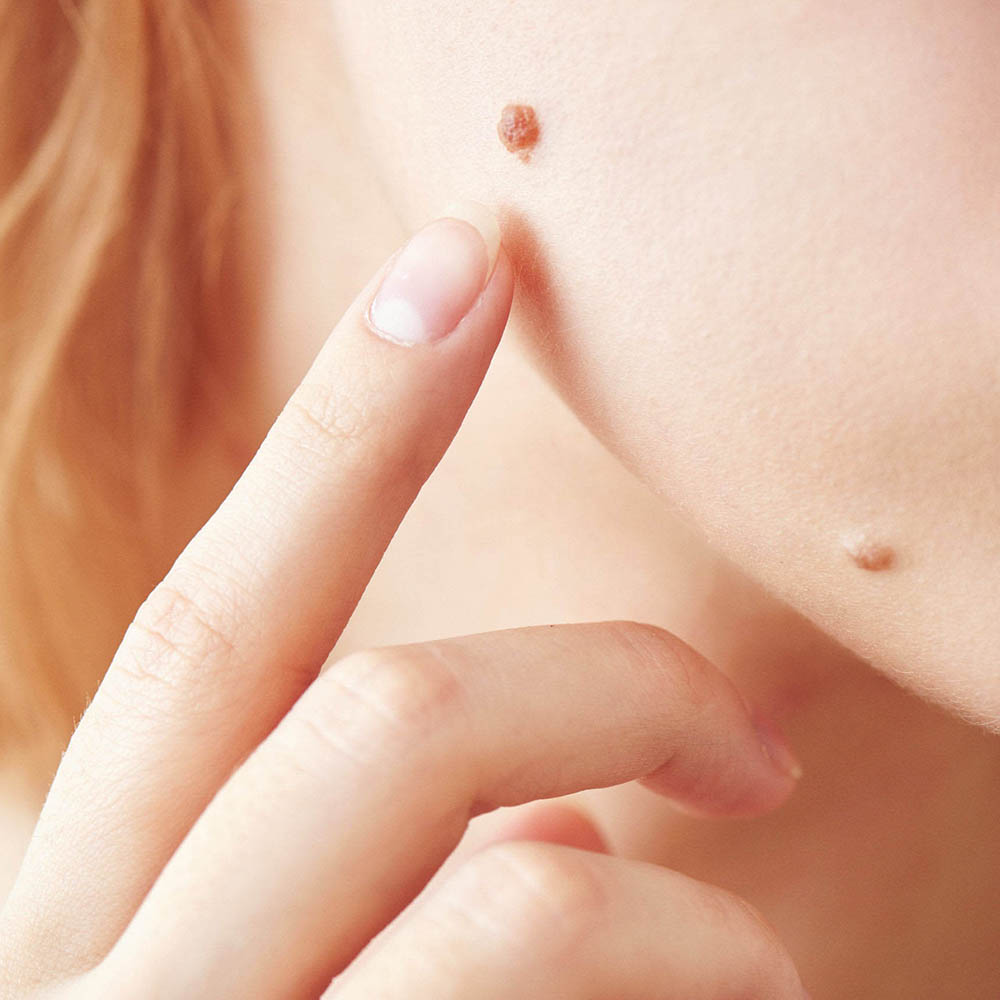 Shave or Curettage of Benign Lesions