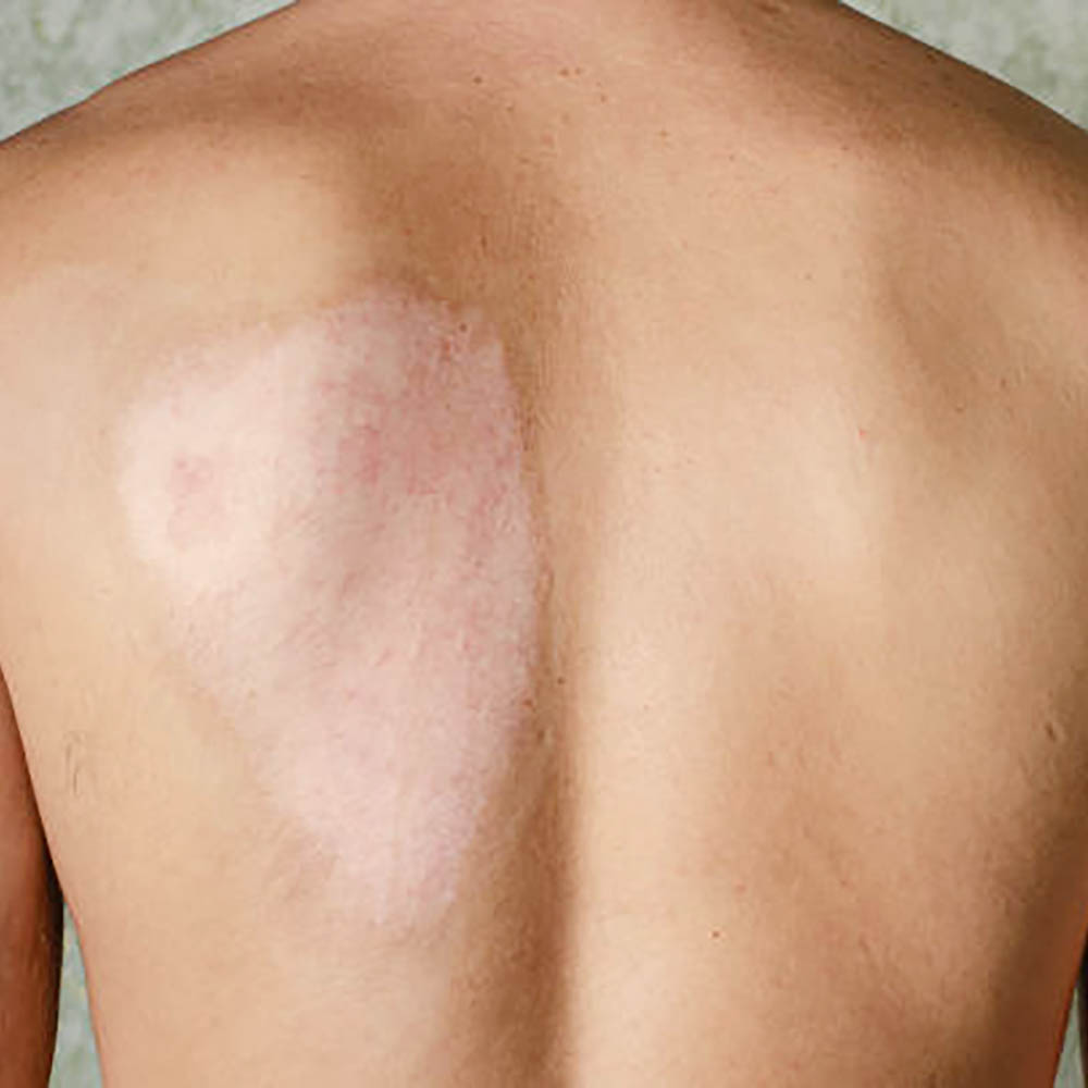 Skin Graft Reconstruction